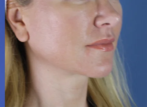 Minimally invasive surgery at Etre Cosmetic Dermatology