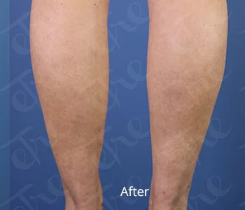Body contouring at Etre Cosmetic Dermatology